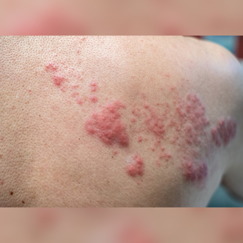 IN THE NEWS – Hodgkin Lymphoma Rash: Understanding Skin Changes